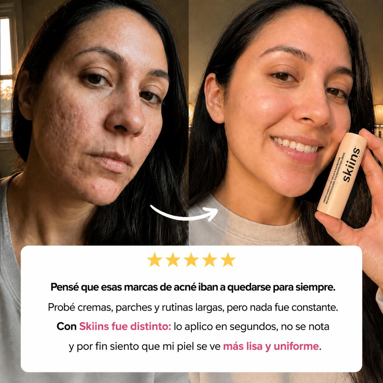 Skiins™ | Stick de Silicona para Marcas de Acné